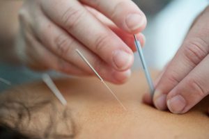 Wellness Evidence Study: Acupuncture Helped Chronic Back Pain Sufferers Walk and Move Better
